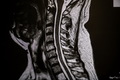 Operácia krčnej chrbtice